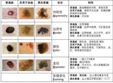 痣變色|痣是什麼？會變成黑色素瘤？7種一定要除的痣